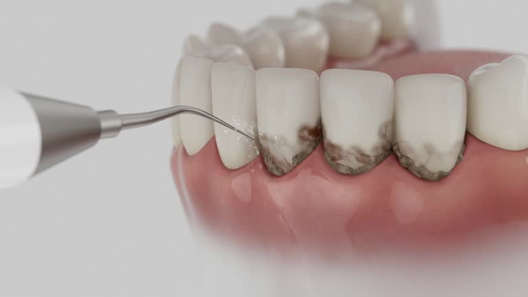 Reliable Dental Implants contractor in Mount Vernon, MO by Smile Center Dentistry